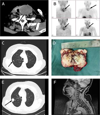 Case Report and Systematic Review: Sarcomatoid Parathyroid Carcinoma—A Rare, Highly Malignant Subtype